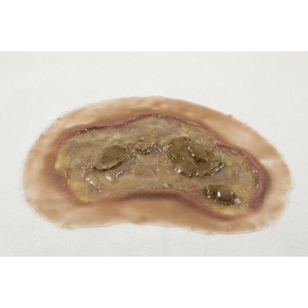 Moulage Science & Training Large Ulcer, Dark MST-45-04-O01